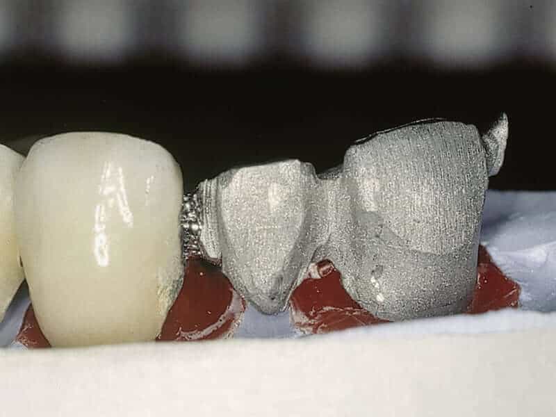 Soldadura láser dental aplicación 5