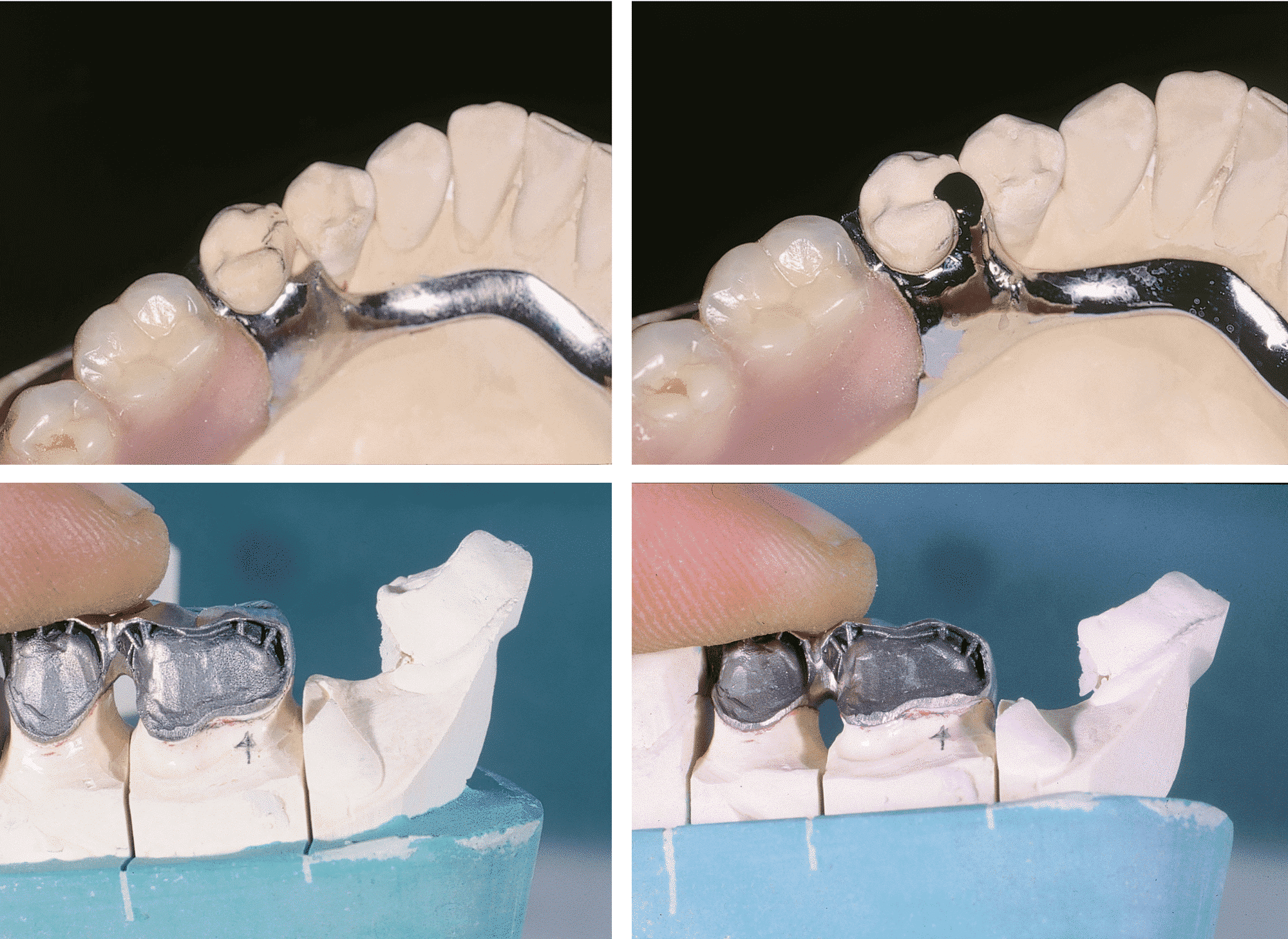 Componentes de implante dental soldados con tecnología láser.