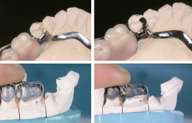 Esempi-di-saldatura-dentale-1 (1)