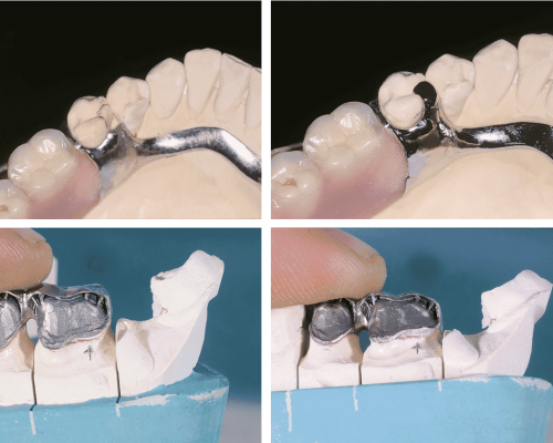 Primer plano de modelos de prótesis dentales con estructura metálica, mostrados desde diferentes ángulos. En las imágenes inferiores, una mano ajusta el modelo.