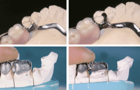 Modelos dentales que muestran dentaduras postizas parciales de metal colocadas sobre moldes de dientes superiores e inferiores en dos etapas.