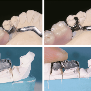 Modelos dentales que muestran dentaduras postizas parciales de metal colocadas sobre moldes de dientes superiores e inferiores en dos etapas.