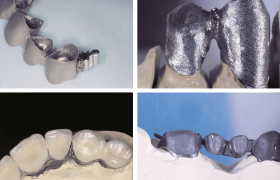 Cuatro imágenes que muestran prótesis dentales: arriba a la izquierda se muestra un puente dental, arriba a la derecha una estructura de metal, abajo a la izquierda dientes con coronas, abajo a la derecha otro puente de metal sobre un modelo.