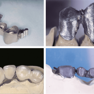 Cuatro imágenes que muestran prótesis dentales: arriba a la izquierda se muestra un puente dental, arriba a la derecha una estructura de metal, abajo a la izquierda dientes con coronas, abajo a la derecha otro puente de metal sobre un modelo.
