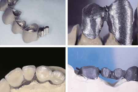 Esempi-di-saldatura-dentale-2 Cuatro imágenes que muestran prótesis dentales: arriba a la izquierda se muestra un puente dental, arriba a la derecha una estructura de metal, abajo a la izquierda dientes con coronas, abajo a la derecha otro puente de metal sobre un modelo.