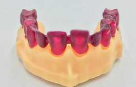 aplicacion-impresion-3d-resina-lpd-dientes-inferiores