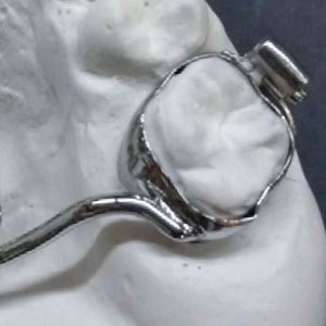 soldadura-laser-dental-aplicacion-1