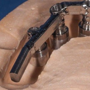 soldadura-laser-dental-aplicacion-2