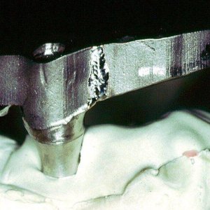 soldadura-laser-dental-aplicacion-3