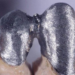 soldadura-laser-dental-aplicacion-4