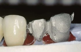 soldadura-laser-dental-aplicacion-5 (1)