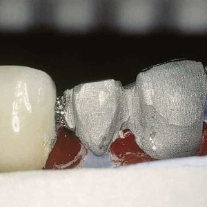 soldadura-laser-dental-aplicacion-5 (1)