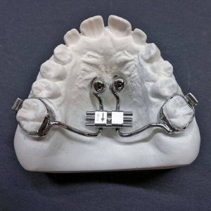 soldadura-laser-dental-aplicacion-puente