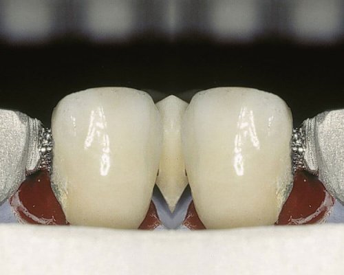 soldadura-laser-dental-seccion