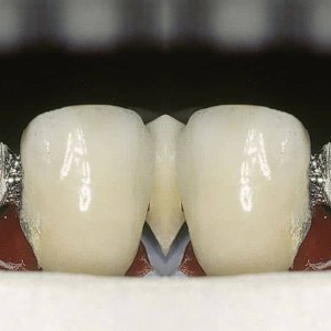 soldadura-laser-dental-seccion