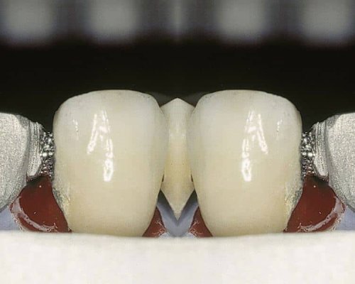 soldadura-laser-dental-seccion